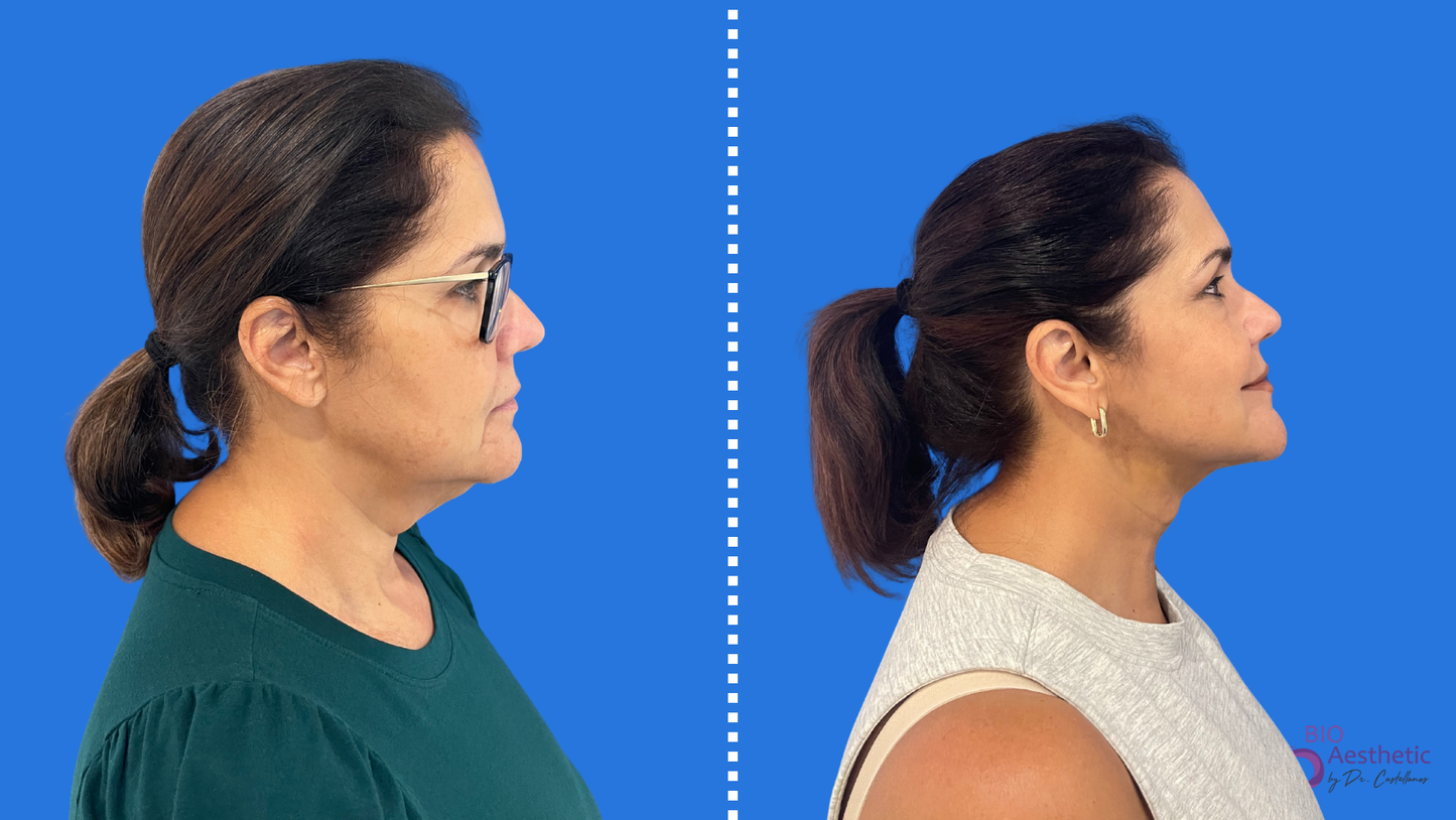 High Definition Chin + Jawline Liposuction Deposit