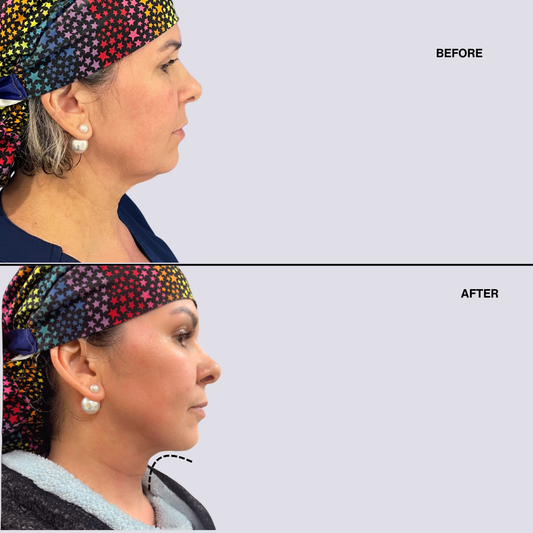 High Definition Chin + Jawline Liposuction Deposit
