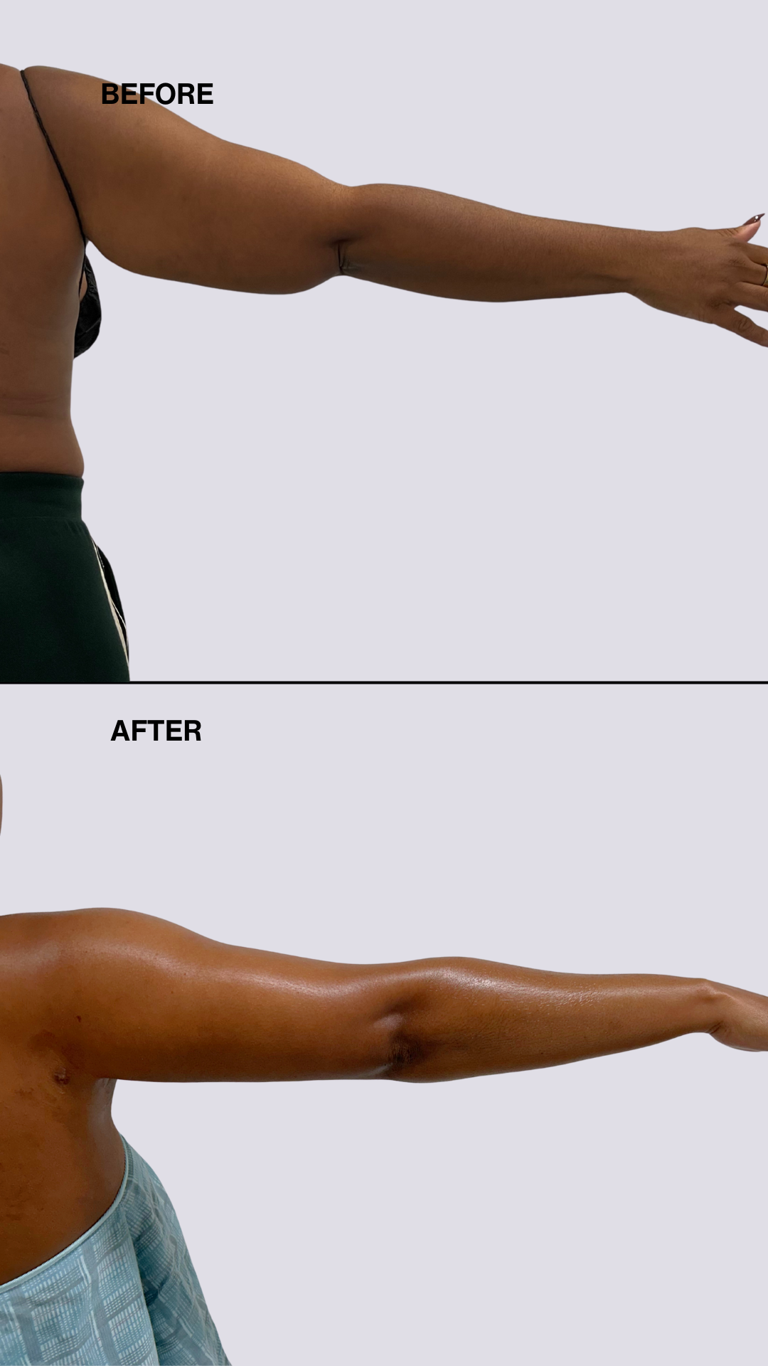 High Definition Arm Liposuction Deposit