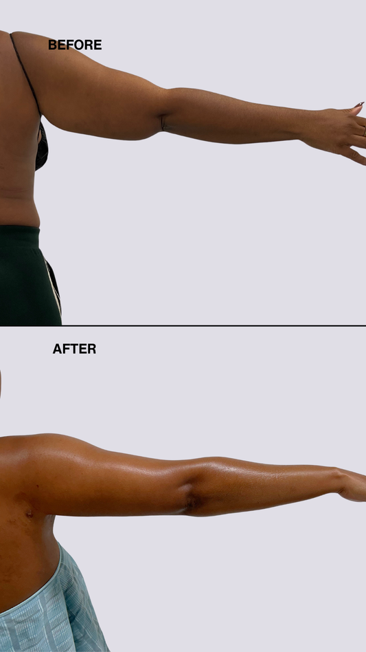 High Definition Arm Liposuction Deposit