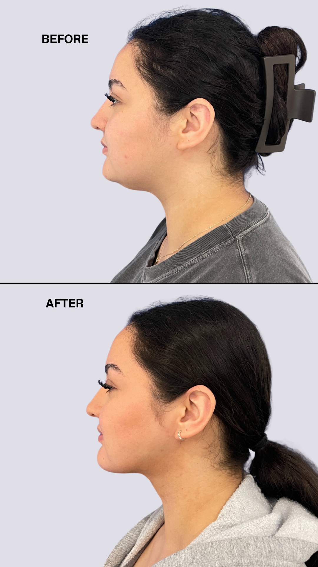 High Definition Chin + Jawline Liposuction Deposit