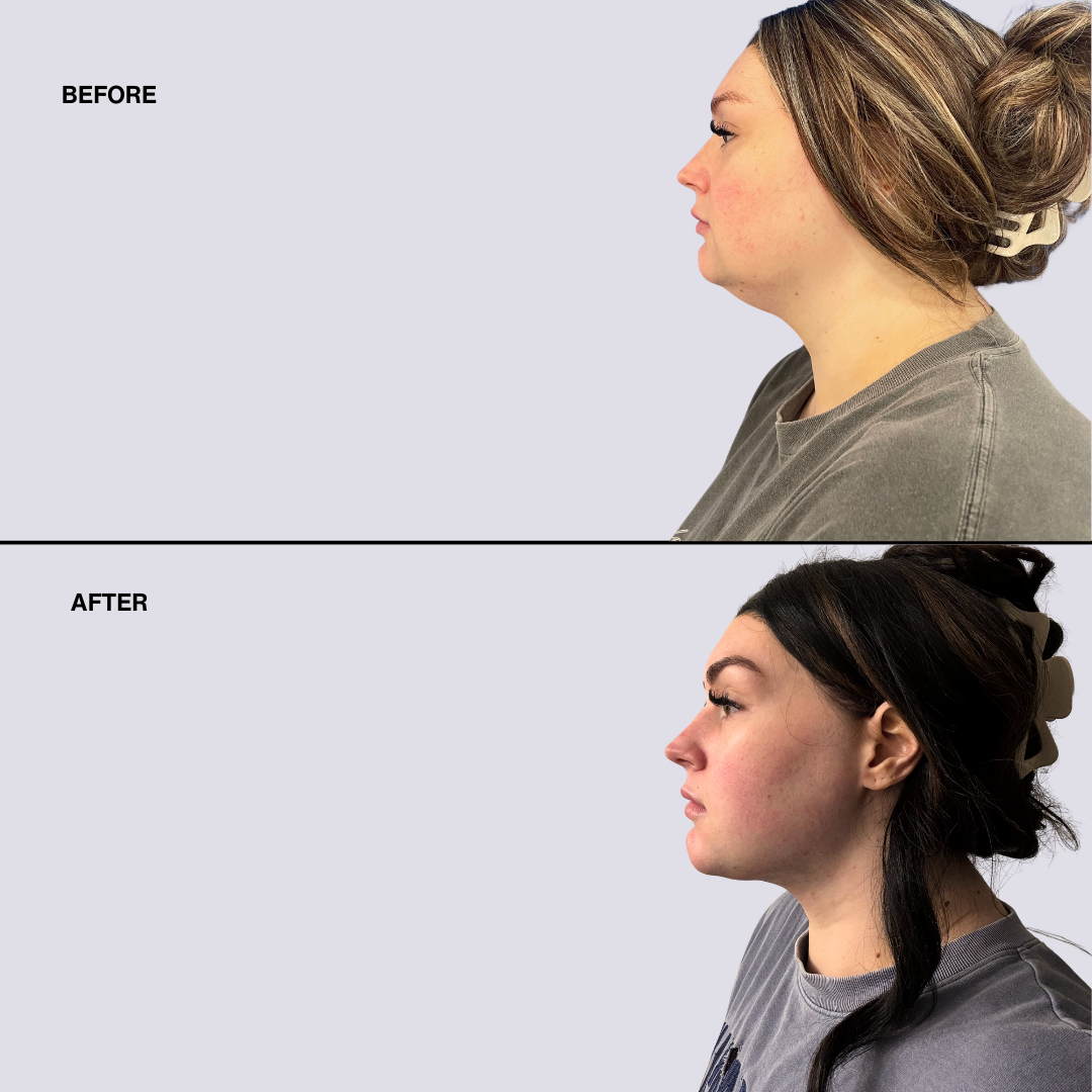 High Definition Chin + Jawline Liposuction Deposit