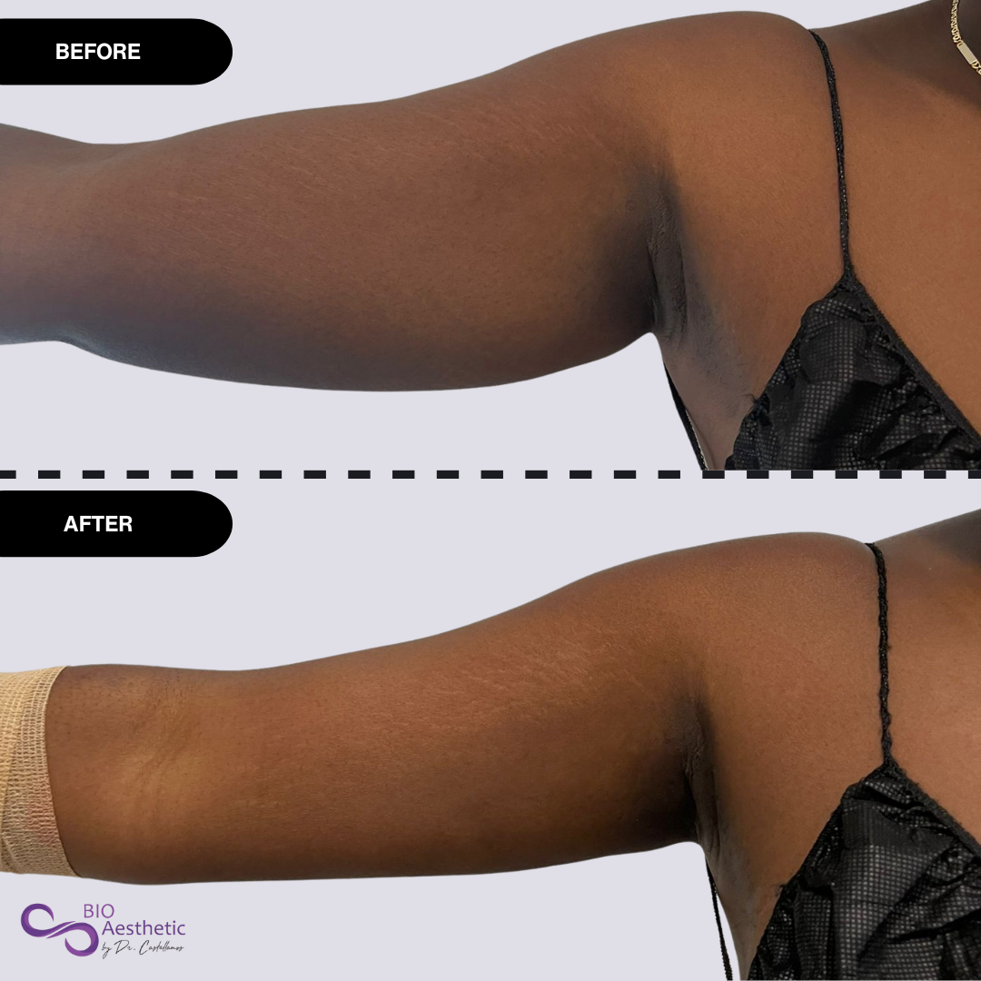 Arm Lipo - Before and After.png__PID:3e4a9c6a-dff4-4821-b6aa-47145f479b80
