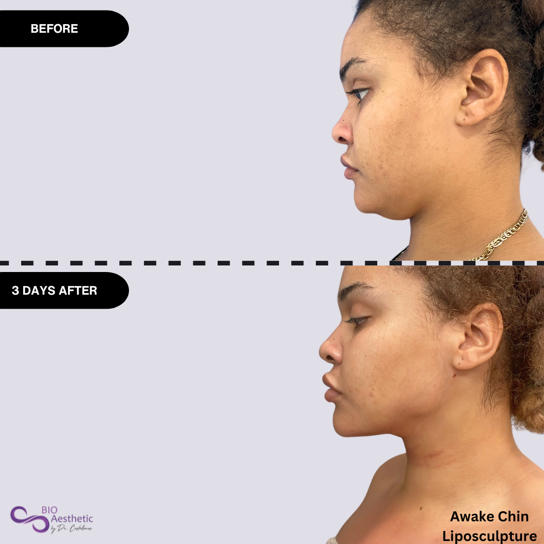 Brittnay Roller - Chin Lipo - Before  After - Instagram Post  (1).png__PID:fdb4cc72-8be0-4da6-b5f7-e7ca8ac8d08b