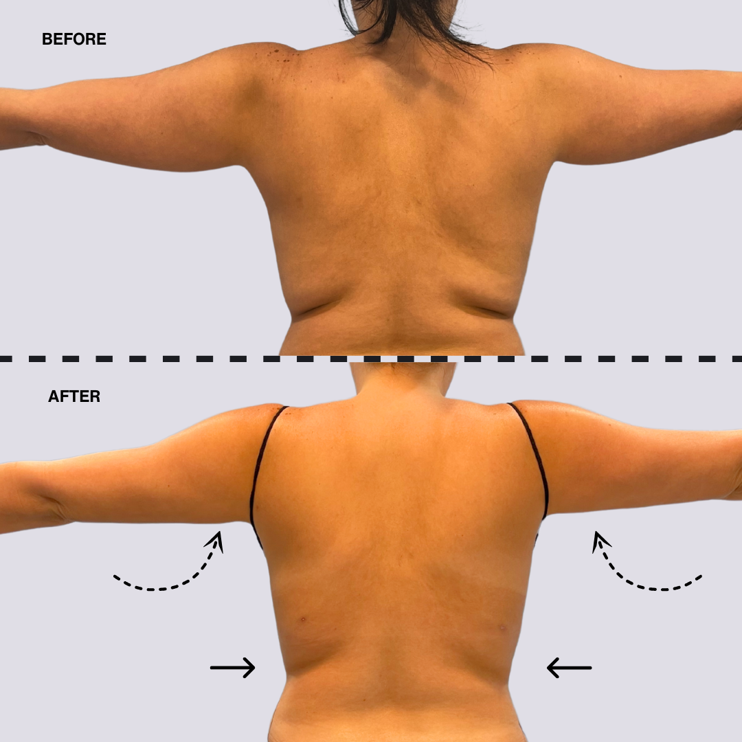 High Definition Arm Liposuction Deposit