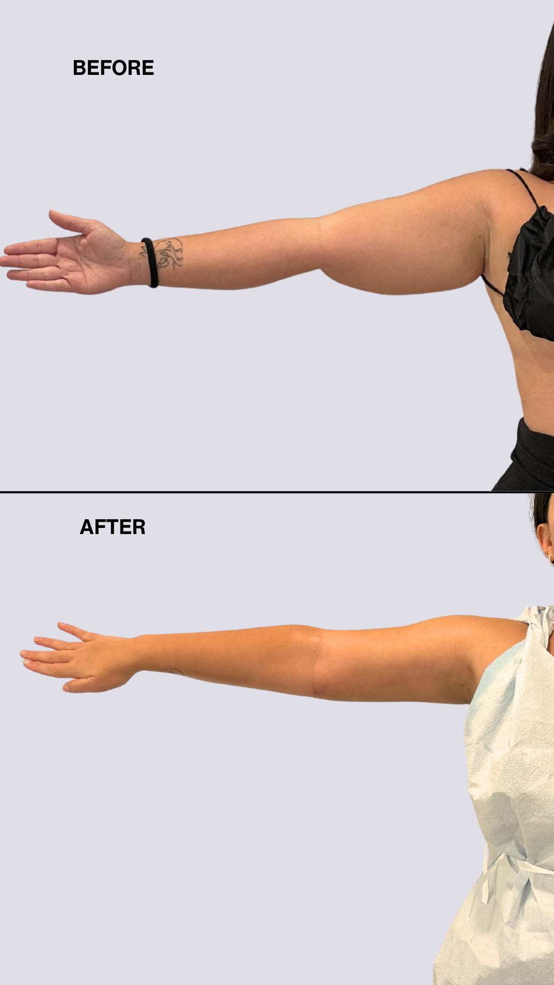 Oniria Cedeno - 5 Days Post OP & 2 WEEKS POST OP- Arm lipo + jplasma - Instagram Story  (1).png__PID:3ead970d-47cb-4287-abfc-3d9a213866be