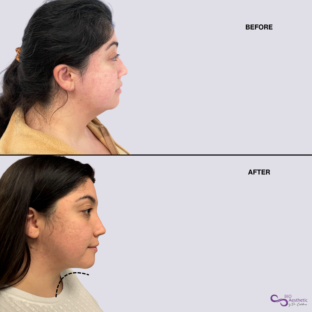 High Definition Chin + Jawline Liposuction Deposit